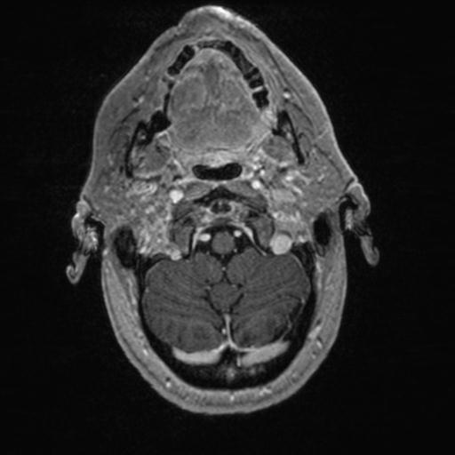 Atypical meningioma (grade II) - en plaque (Radiopaedia 29633-30147 Axial T1 C+ 27).jpg