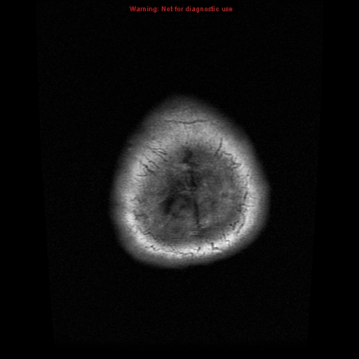 File:Atypical meningioma - grade II (Radiopaedia 13303-13305 Axial T1 22).jpg