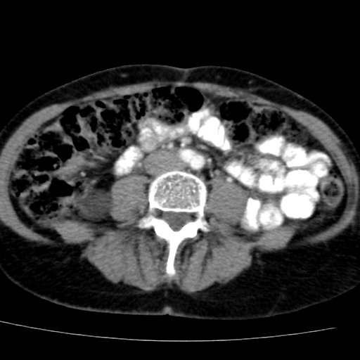 File:Atypical renal cyst (Radiopaedia 17536-17251 renal cortical phase 29).jpg