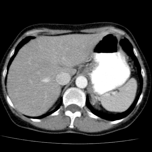 File:Atypical renal cyst (Radiopaedia 17536-17251 renal cortical phase 3).jpg