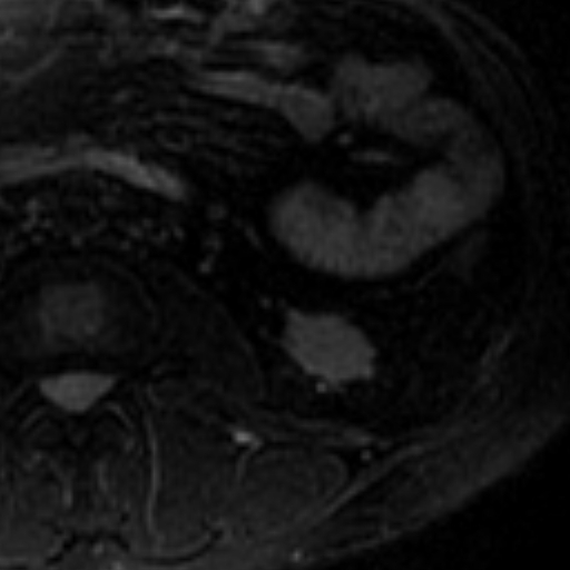 File:Atypical renal cyst on MRI (Radiopaedia 17349-17046 Axial T2 fat sat 21).jpg