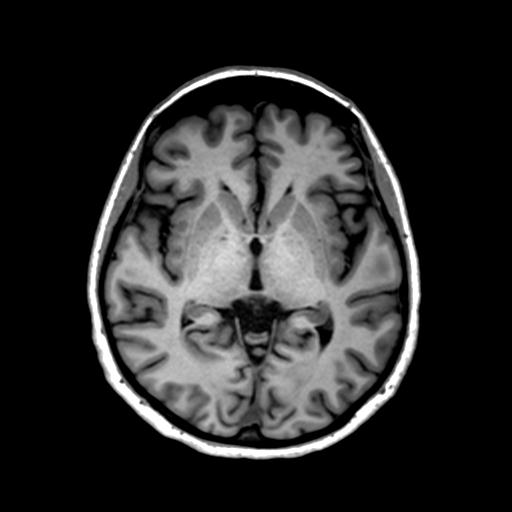 Autoimmune limbic encephalitis (Radiopaedia 30363-31005 T1 Axial 1mm 75).jpg