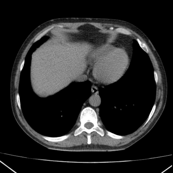 File:Autosomal dominant polycystic kidney disease (Radiopaedia 36539-38101 Axial non-contrast 7).jpg