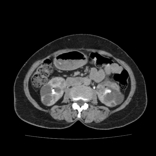 File:Autosomal dominant polycystic kidney disease (Radiopaedia 38189-40194 Axial C+ delayed 25).jpg