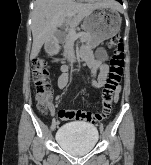 File:Autosomal dominant polycystic kidney disease (Radiopaedia 38189-40194 Coronal C+ delayed 30).jpg