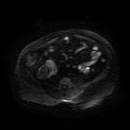 Autosomal dominant polycystic kidney disease (Radiopaedia 50259-55611 Axial DWI 69).jpg