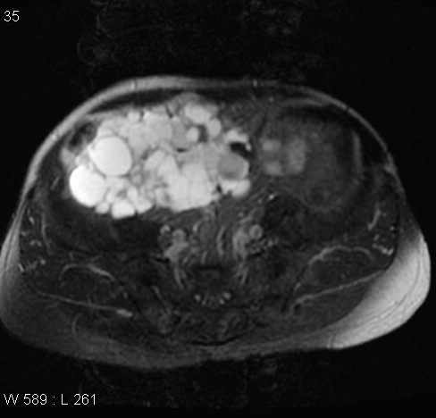 File:Autosomal dominant polycystic kidney disease (Radiopaedia 5202-6969 Axial T2 fat sat 15).jpg