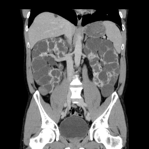Autosomal dominant polycystic kidney disease (Radiopaedia 66349-75582 A 46).jpg