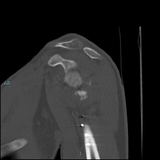 File:Avascular necrosis after fracture dislocations of the proximal humerus (Radiopaedia 88078-104653 Sagittal bone window 32).jpg