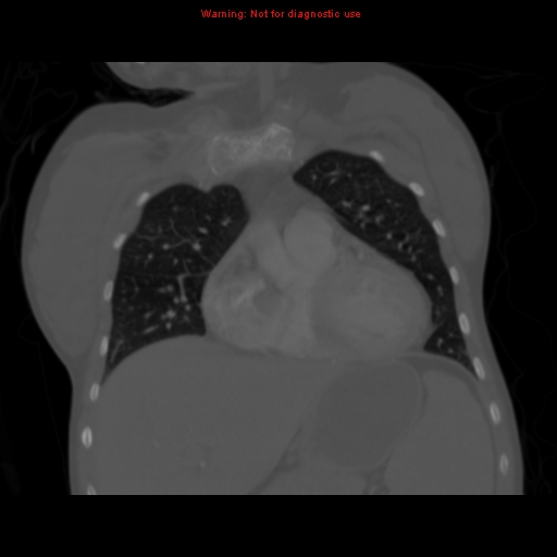 Avascular necrosis in sickle cell disease (Radiopaedia 17448-17152 Coronal bone window 39).jpg