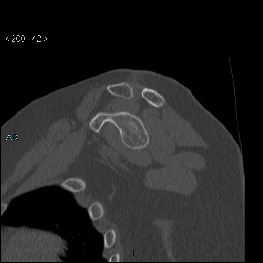 Avascular necrosis of the shoulder - Cruess stage I (Radiopaedia 77674-89887 Sagittal bone window 41).jpg