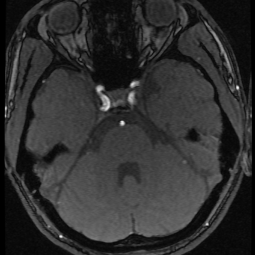 Azygos anterior cerebral artery (Radiopaedia 17059-16756 Axial MRA 58).jpg