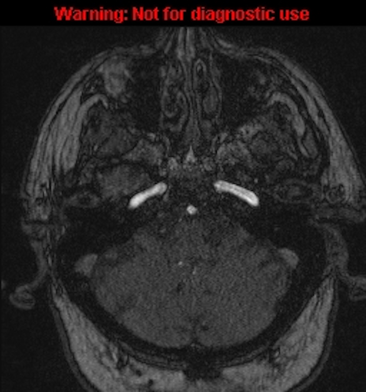 Azygos anterior cerebral artery (Radiopaedia 59325-66677 Axial MRA 28).jpg