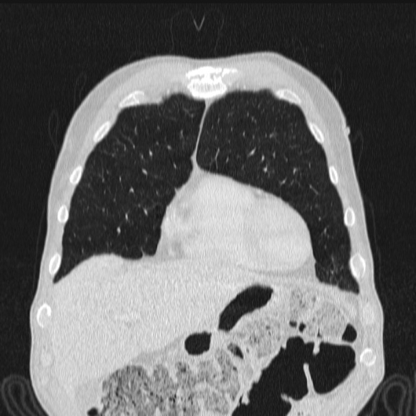 Azygos lobe (Radiopaedia 38259-40275 Coronal lung window 18).jpg