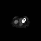 B-cell lymphoma of the mesentery (Radiopaedia 65743-74868 18F-FDG PET-CT 185).jpg