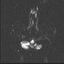 Balo concentric sclerosis (Radiopaedia 50458-55940 Axial DWI 44).jpg