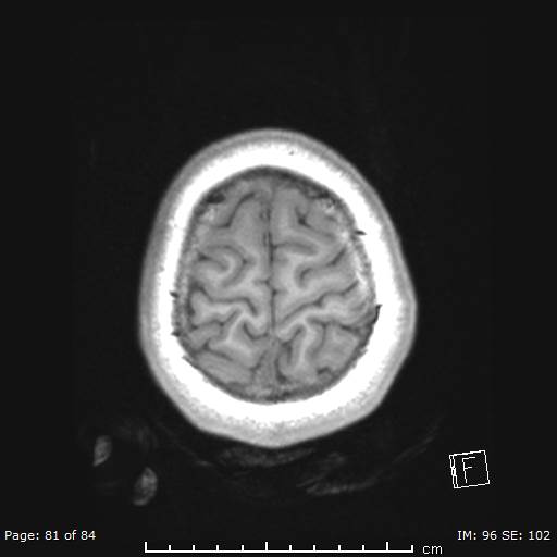 Balo concentric sclerosis (Radiopaedia 61637-69636 Axial T1 81).jpg