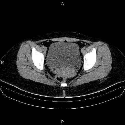 Bartholin gland cyst (Radiopaedia 62635-70930 Axial non-contrast 57).jpg