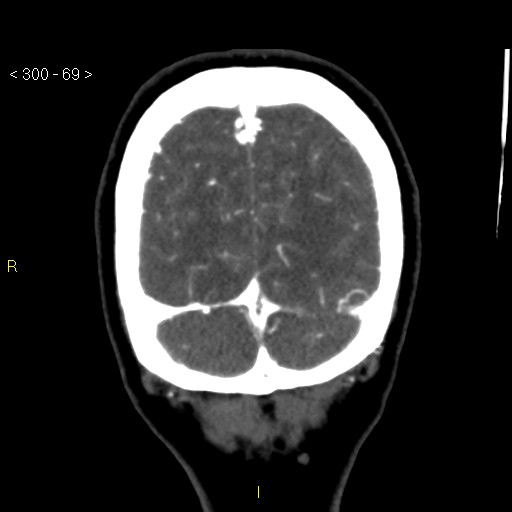 File:Basilar artery thrombosis (Radiopaedia 16260-15944 B 60).jpg