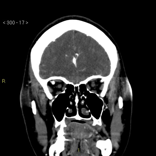 Basilar artery thrombosis (Radiopaedia 16260-15944 B 8).jpg