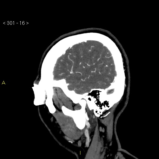 Basilar artery thrombosis (Radiopaedia 16260-15944 C 10).jpg