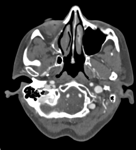 Basilar tip aneurysm with coiling (Radiopaedia 53912-60086 A 22).jpg
