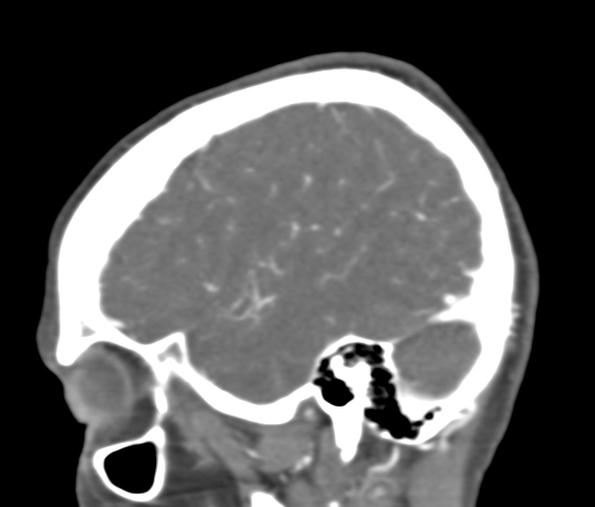Basilar tip aneurysm with coiling (Radiopaedia 53912-60086 C 22).jpg