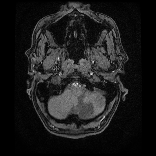 Basilar top and left middle cerebral artery aneurysm (Radiopaedia 61965-70031 Axial MRA 4).jpg