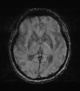 File:Behavioral variant frontotemporal dementia and late onset schizophrenia (Radiopaedia 52197-58083 Axial SWI 37).png