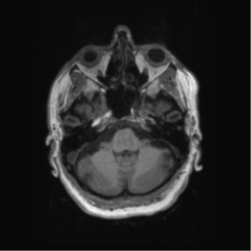 Behavioral variant frontotemporal dementia and late onset schizophrenia (Radiopaedia 52197-58083 Axial T1 88).png