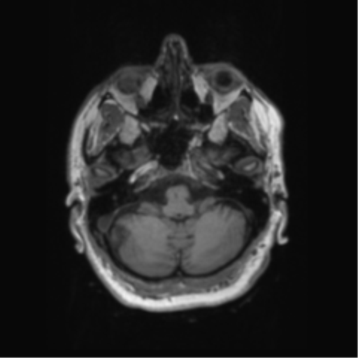 Behavioral variant frontotemporal dementia and late onset schizophrenia (Radiopaedia 52197-58083 Axial T1 90).png
