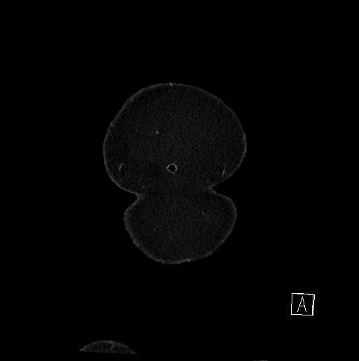 Below filter IVC thrombosis (Radiopaedia 58187-65266 B 10).jpg