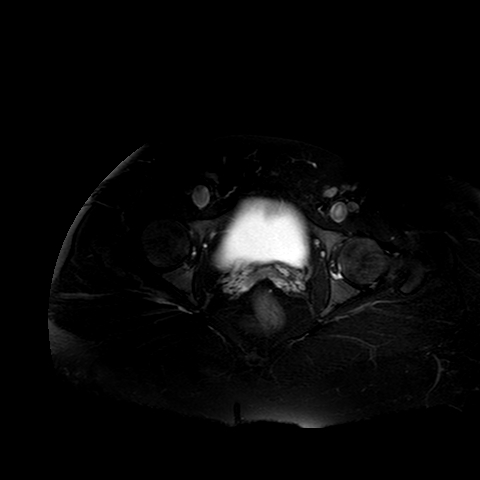 File:Benign seromucinous cystadenoma of the ovary (Radiopaedia 71065-81300 T2 SPAIR 4).jpg