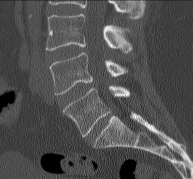 Bertolotti syndrome (Radiopaedia 24864-25128 Sagittal bone window 26).jpg