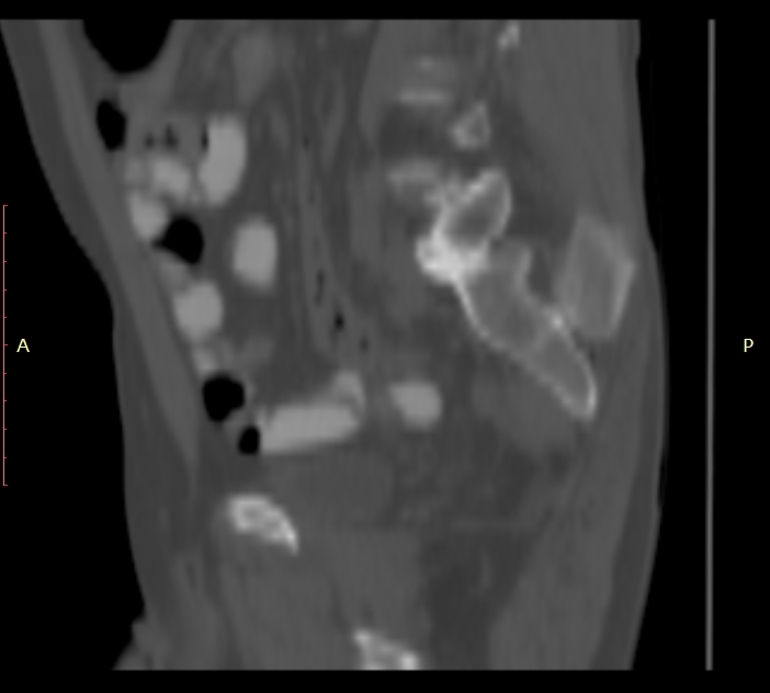 Bertolotti syndrome (Radiopaedia 58974-66235 Sagittal bone window 43).jpg
