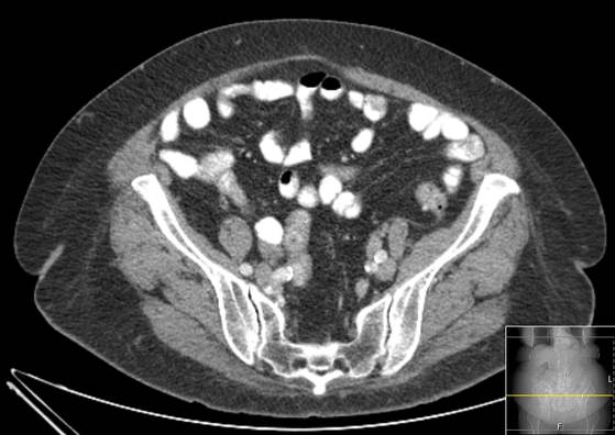 Bicameral celiacomesenteric aneurysm (Radiopaedia 55766-62327 A 52).jpg