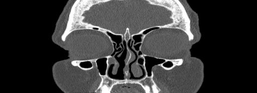 Bilateral Ectopic Infraorbital Nerves (Radiopaedia 49006-54084 Coronal bone window 12).jpg