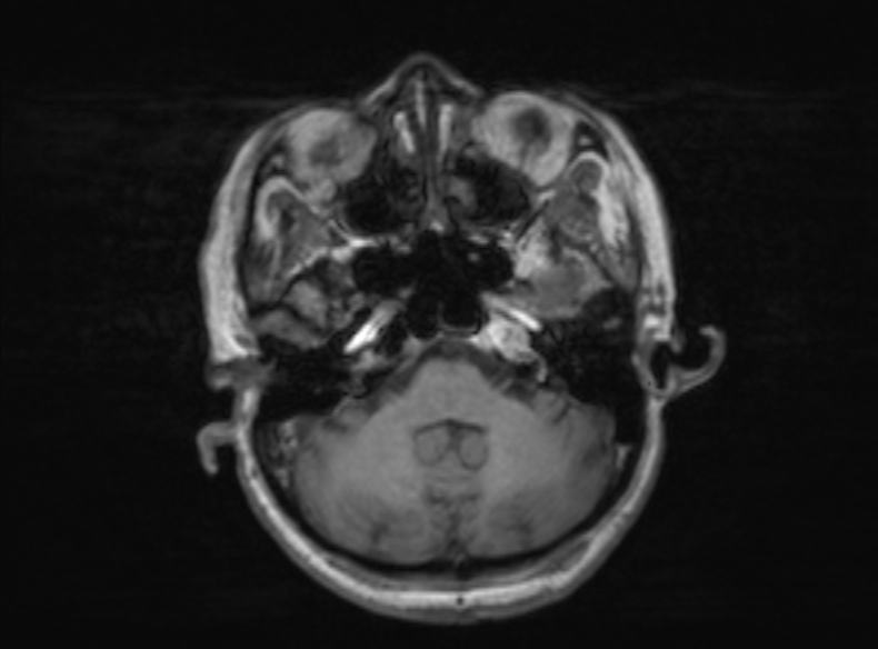 File:Bilateral PCA territory infarction - different ages (Radiopaedia 46200-51784 Axial T1 310).jpg