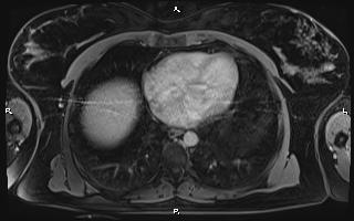 File:Bilateral adrenal myelolipoma (Radiopaedia 63058-71537 H 7).jpg