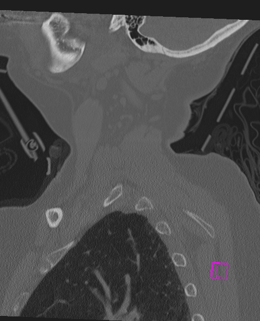 Bilateral atlanto-occipital assimilation (Radiopaedia 28350-28603 Sagittal bone window 11).jpg