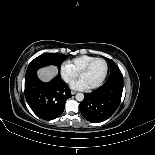 Bilateral benign adrenal adenomas (Radiopaedia 86912-103124 B 8).jpg