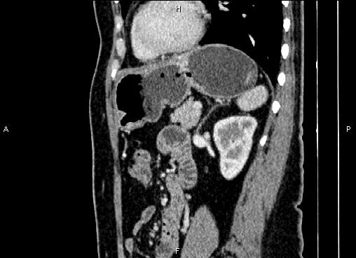 Bilateral benign adrenal adenomas (Radiopaedia 86912-103124 E 66).jpg