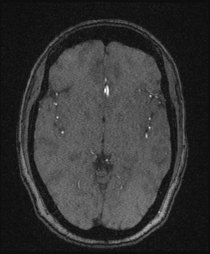 Bilateral carotid body tumors and right glomus jugulare tumor (Radiopaedia 20024-20060 Axial MRA 90).jpg