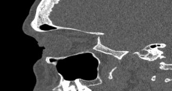 File:Bilateral ectopic infraorbital nerves (Radiopaedia 49006-54084 Sagittal 30).png