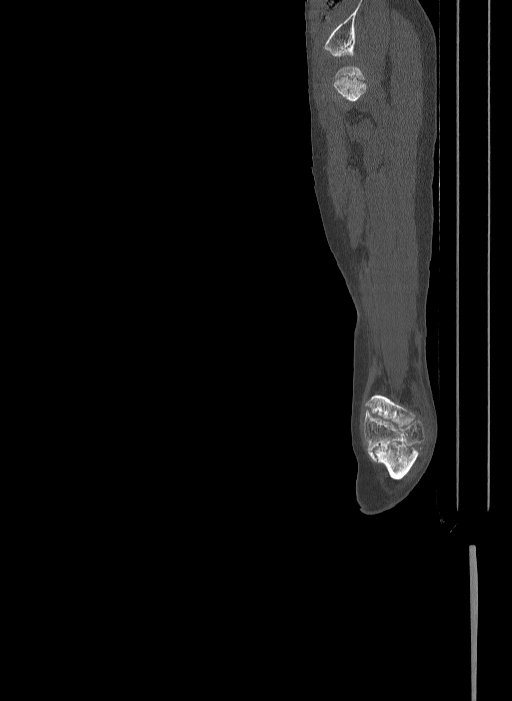 Bilateral fibular hemimelia type II (Radiopaedia 69581-79491 Sagittal bone window 65).jpg