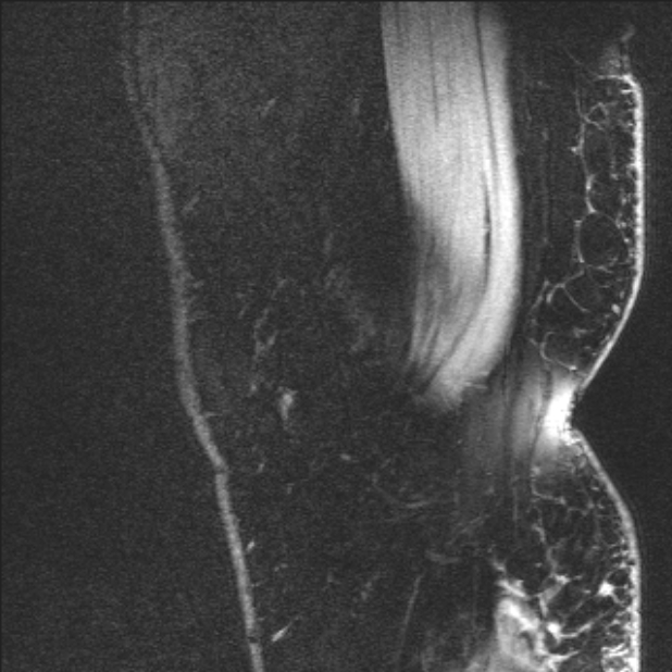 Bilateral focal pigmented villonodular synovitis (Radiopaedia 67643-77046 G 1).jpg
