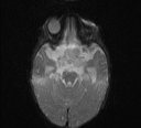 File:Bilateral optic pathway gliomas (Radiopaedia 40013-42514 Axial DWI 5).jpg