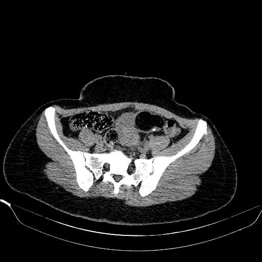 File:Bilateral ovarian dermoid (Radiopaedia 45714-49907 Axial non-contrast 13).JPEG