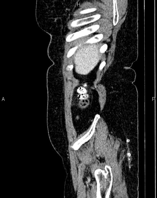 Bilateral ovarian serous cystadenocarcinoma (Radiopaedia 86062-101989 E 5).jpg