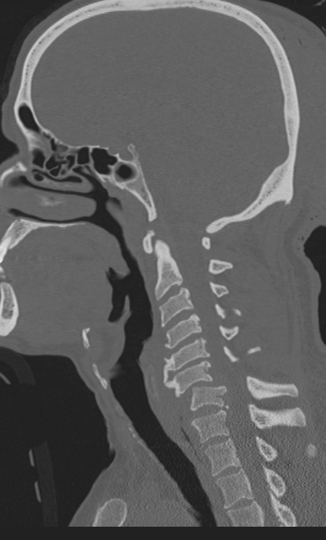 Bilateral perched facet joint (Radiopaedia 63149-71669 Sagittal bone window 34).jpg